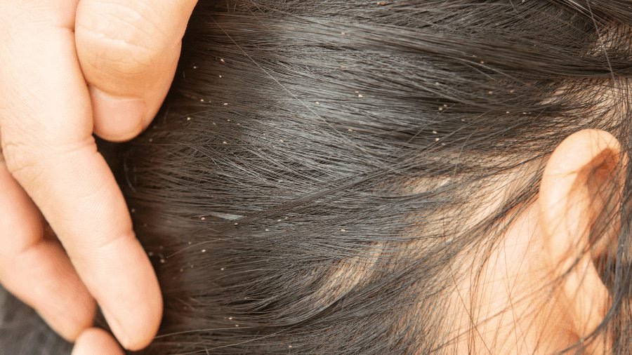 Verano: Prevención por contagios de piojos en los niños.