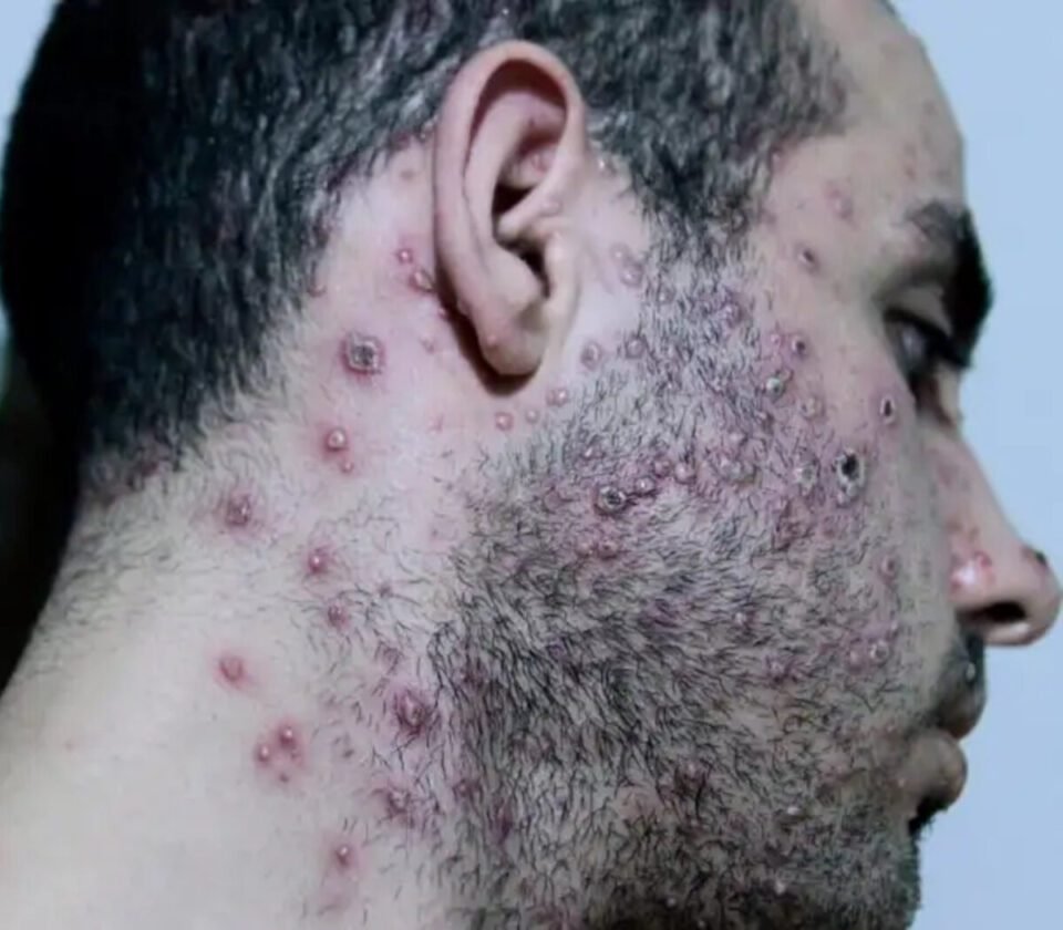 Viruela del Mono: Se confirma la segunda muerte en el País.