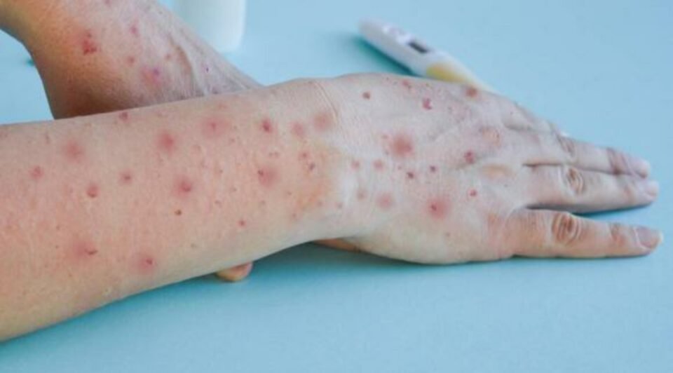 Qué es y cómo prevenir la viruela del mono 