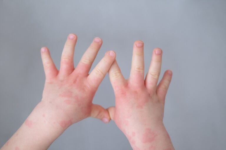 Hoy 14 de septiembre, Día Mundial de la Dermatitis Atópica