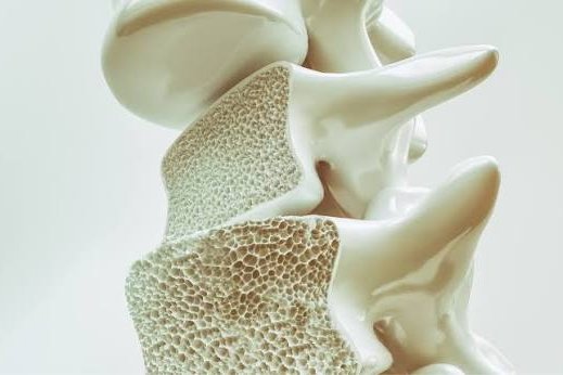 Hoy 20 de octubre, Día Mundial de la Osteoporosis  Hoy 20 de octubre, Día Mundial de la Osteoporosis