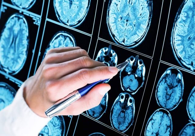 Alzheimer: Prueban una inmunoterapia que frenó la enfermedad 