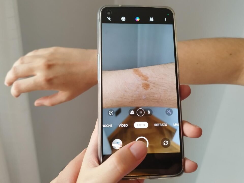 Una app detecta cáncer de piel con la cámara del celular 