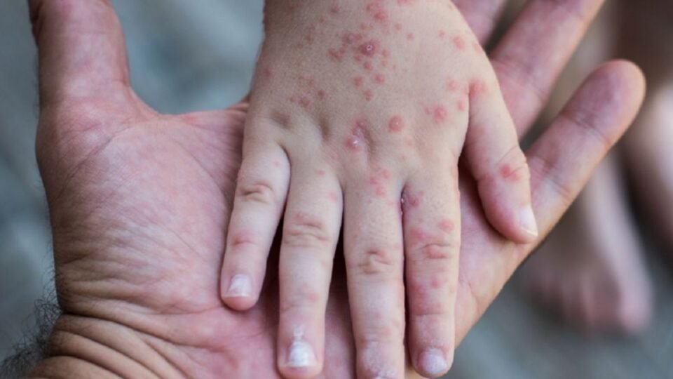Hoy 14 de septiembre, Día Mundial de la Dermatitis Atópica